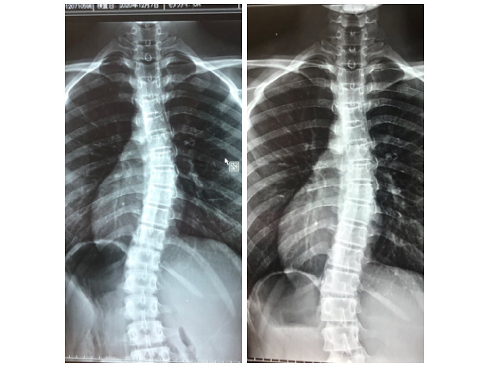 症例ケース4. 脊柱側弯症