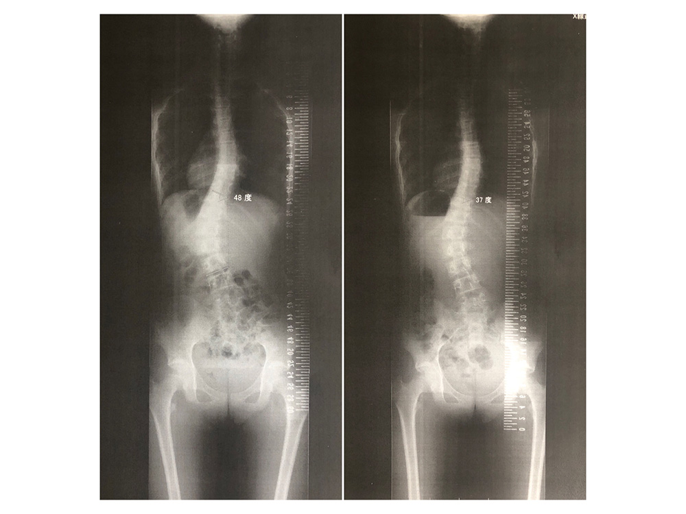 症例ケース2. 側弯症